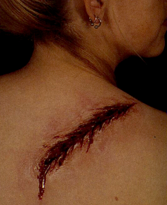 BACK LASH WOUND