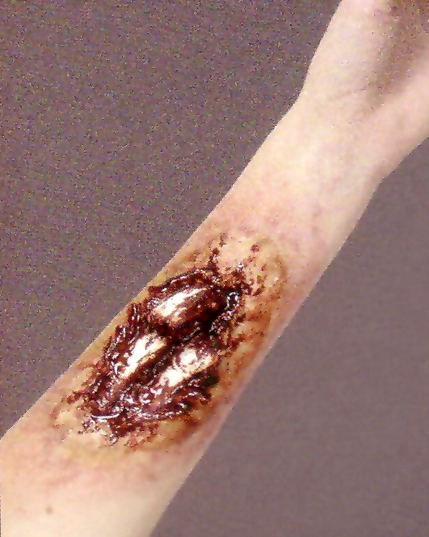 COMPOUND FRACTURE WOUND