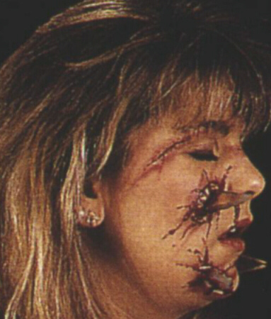 GLASS ATTACK WOUND